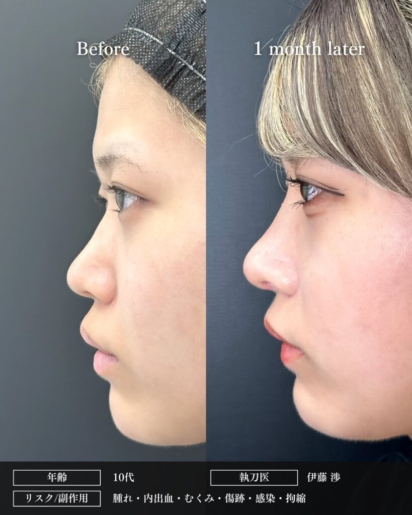 鼻中隔延長と鼻尖形成と軟骨移植と小鼻縮小と鼻柱下降とプロテーゼの症例写真 (7)