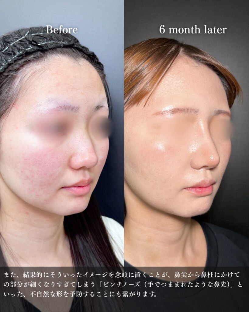 鼻尖形成と耳介軟骨移植とプロテーゼの症例写真 (9)