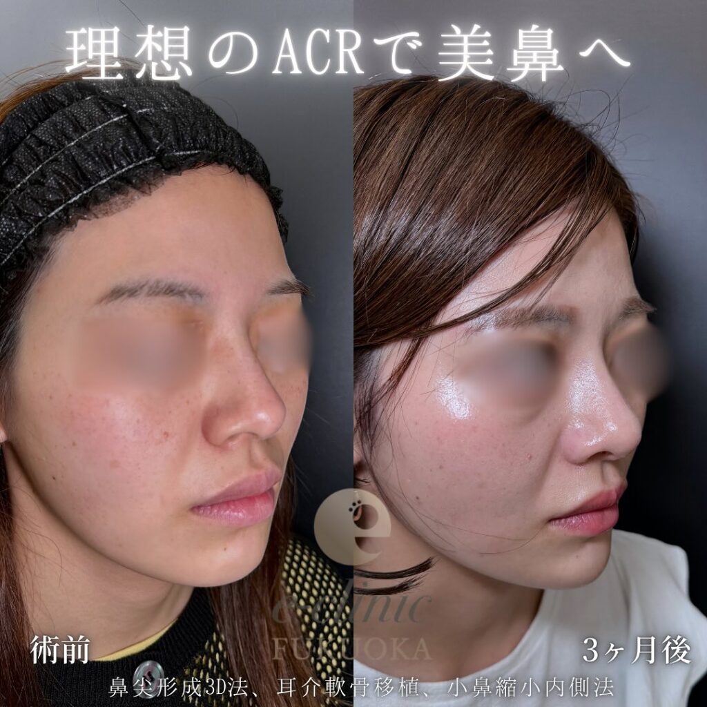 鼻尖形成と軟骨移植と小鼻縮小の症例写真 (14)