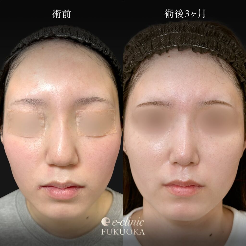 鼻尖形成と軟骨移植と鼻柱下降の症例写真 (3)