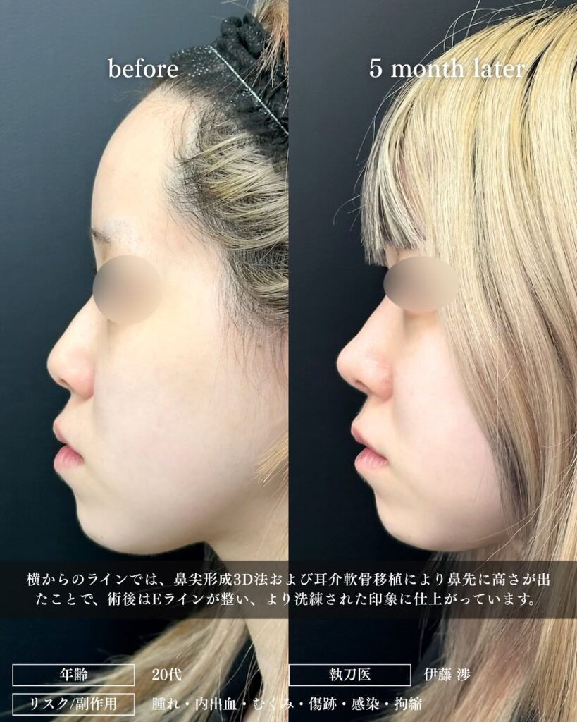 鼻尖形成と軟骨移植と小鼻縮小の症例写真 (29)