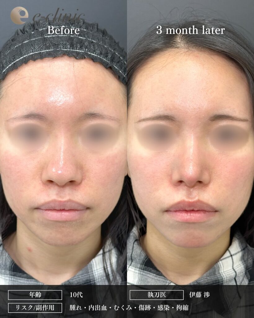 鼻尖形成と軟骨移植と小鼻縮小の症例写真 (40)