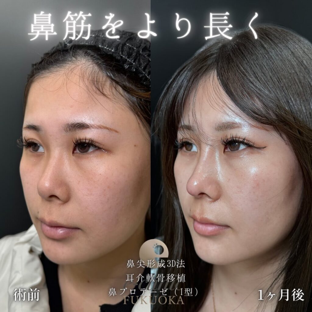 鼻尖形成と軟骨移植とプロテーゼの症例写真 (5)