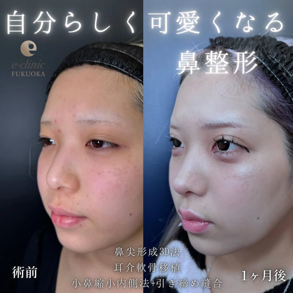 鼻尖形成と耳介軟骨移植と小鼻縮小の症例写真 (1)
