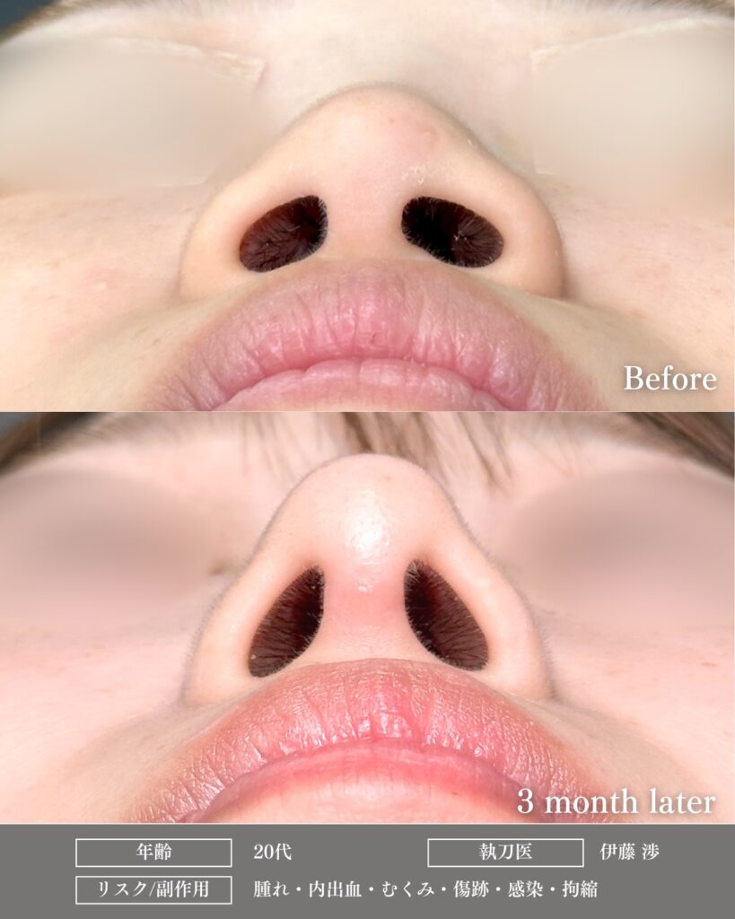 鼻中隔延長と鼻尖形成と軟骨移植とプロテーゼの症例写真 (9)