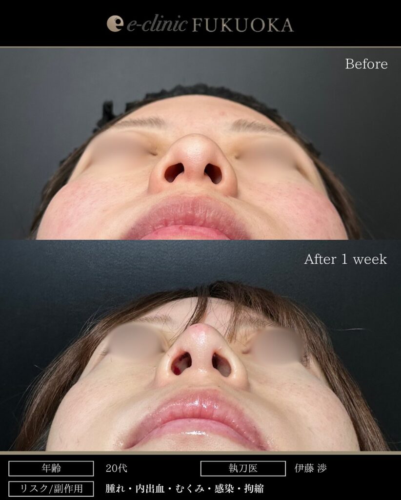 鼻尖形成と軟骨移植の症例写真 (21)