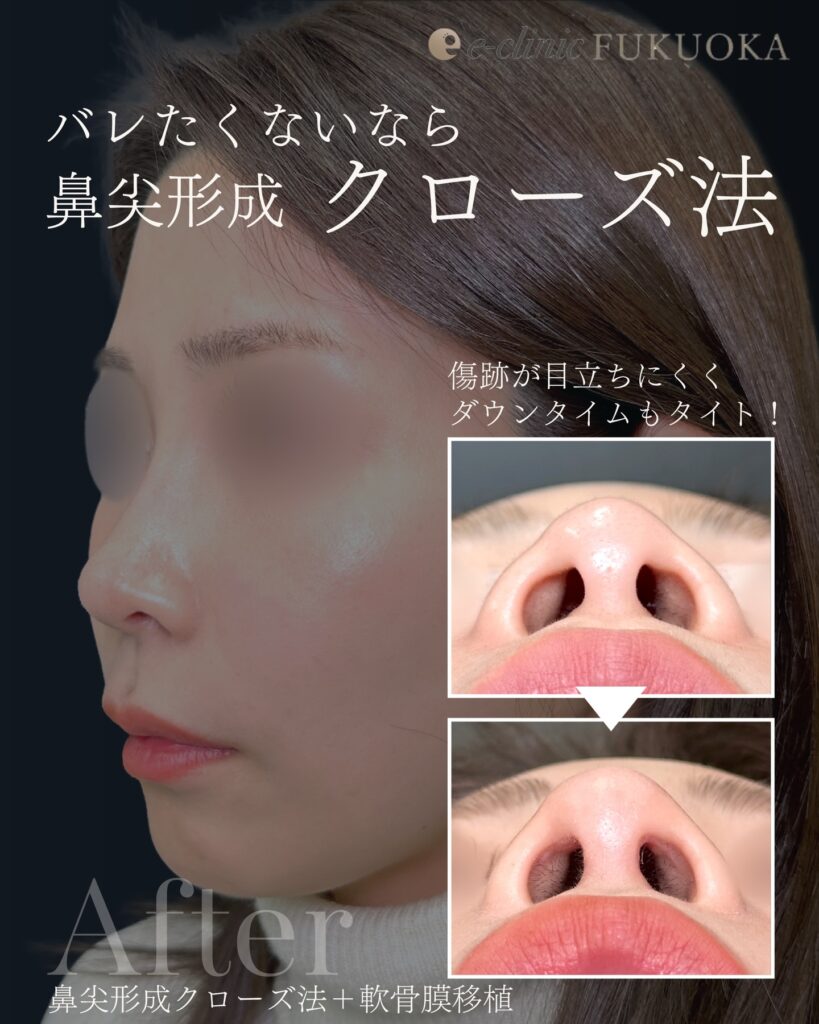 鼻尖形成と軟骨移植の症例写真 (39)