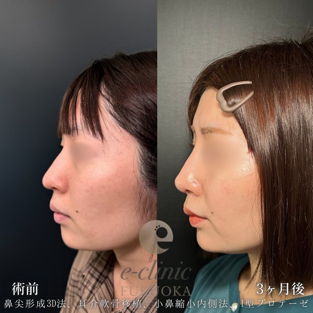 鼻尖形成と軟骨移植と小鼻縮小とプロテーゼの症例写真 (5)