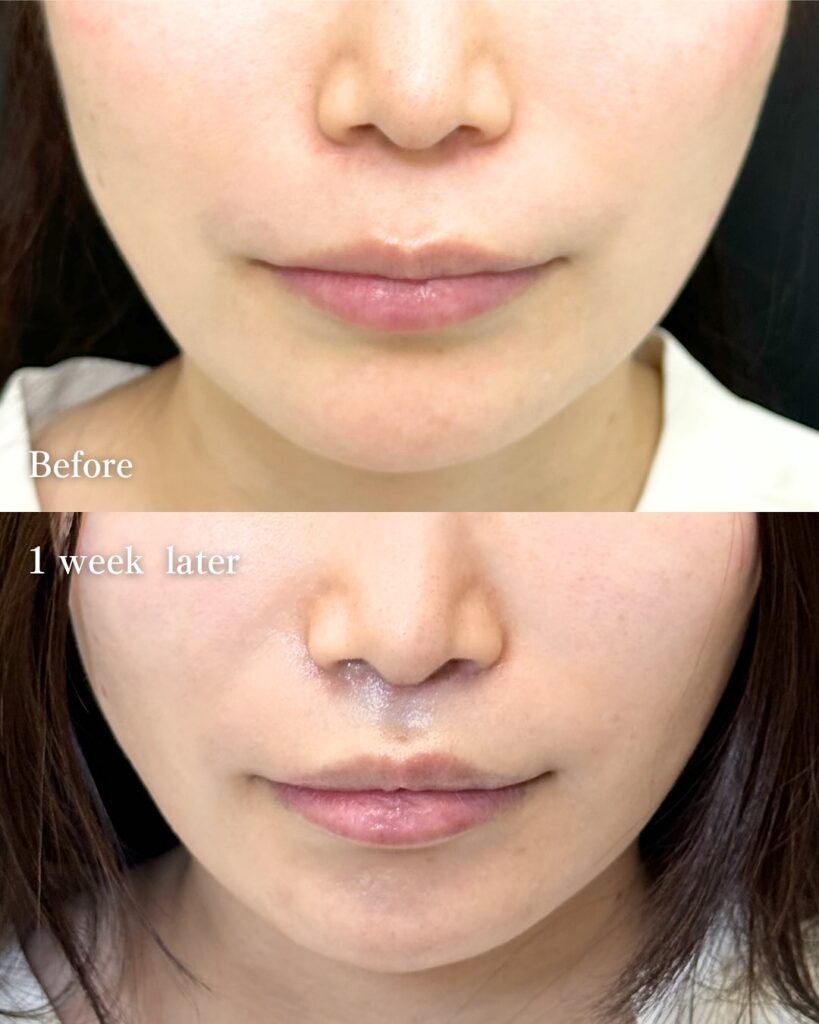 人中短縮の症例写真 (17)