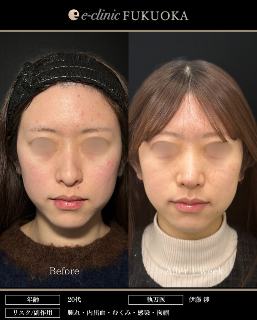 鼻尖形成と軟骨移植の症例写真 (19)