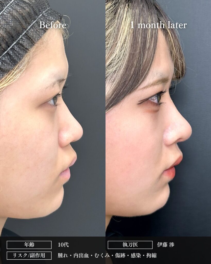 鼻中隔延長と鼻尖形成と軟骨移植と小鼻縮小と鼻柱下降とプロテーゼの症例写真 (6)