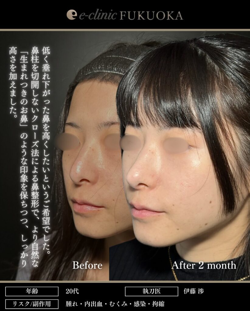 鼻尖形成と軟骨移植の症例写真 (28)