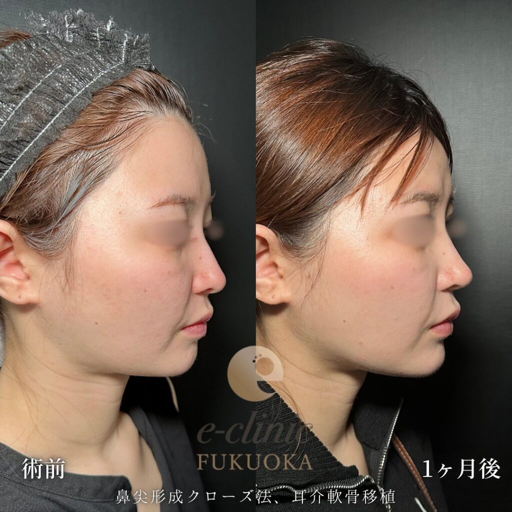 鼻尖形成と軟骨移植の症例写真 (7)