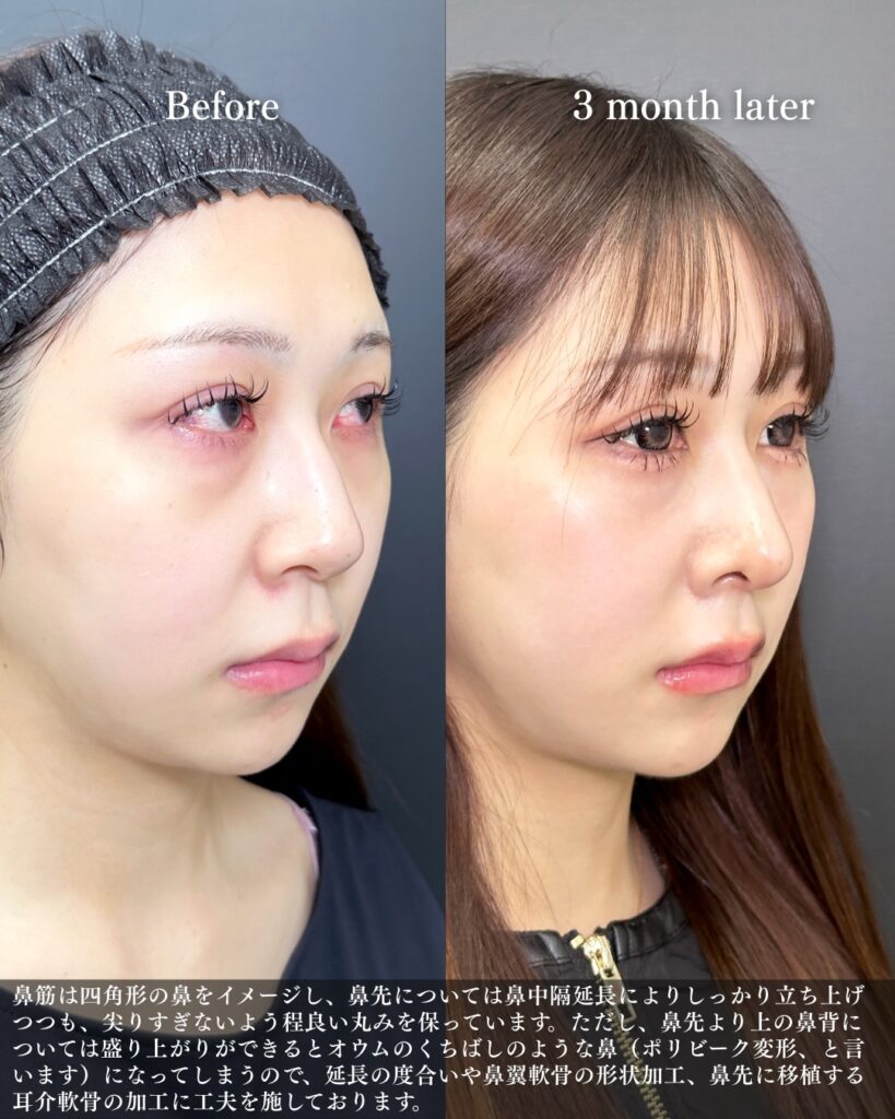 鼻中隔延長と鼻尖形成と軟骨移植と鷲鼻修正の症例写真 (9)