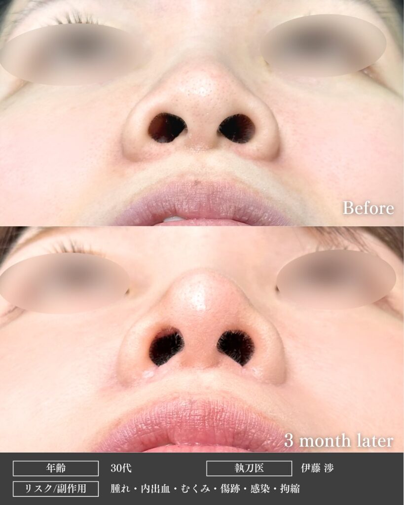 鼻尖形成と軟骨移植と小鼻縮小と裏ハムラ法と脂肪注入の症例写真 (5)