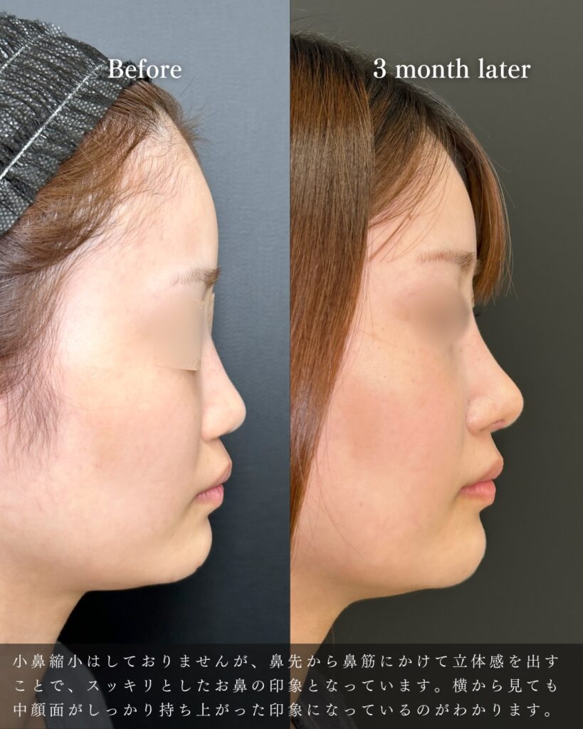 鼻中隔延長と鼻尖形成と軟骨移植とプロテーゼの症例写真 (10)