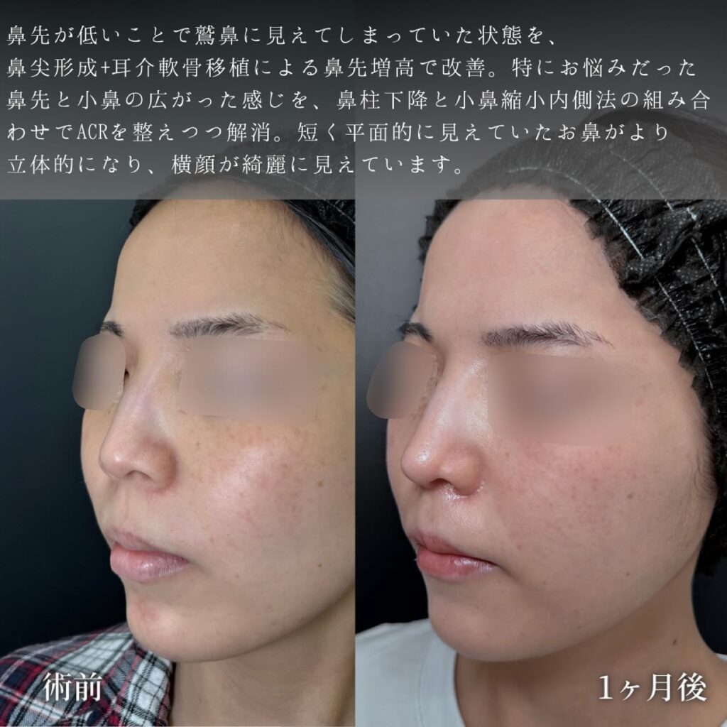 鼻尖形成と軟骨移植と鼻柱下降と小鼻縮小の症例写真 (4)