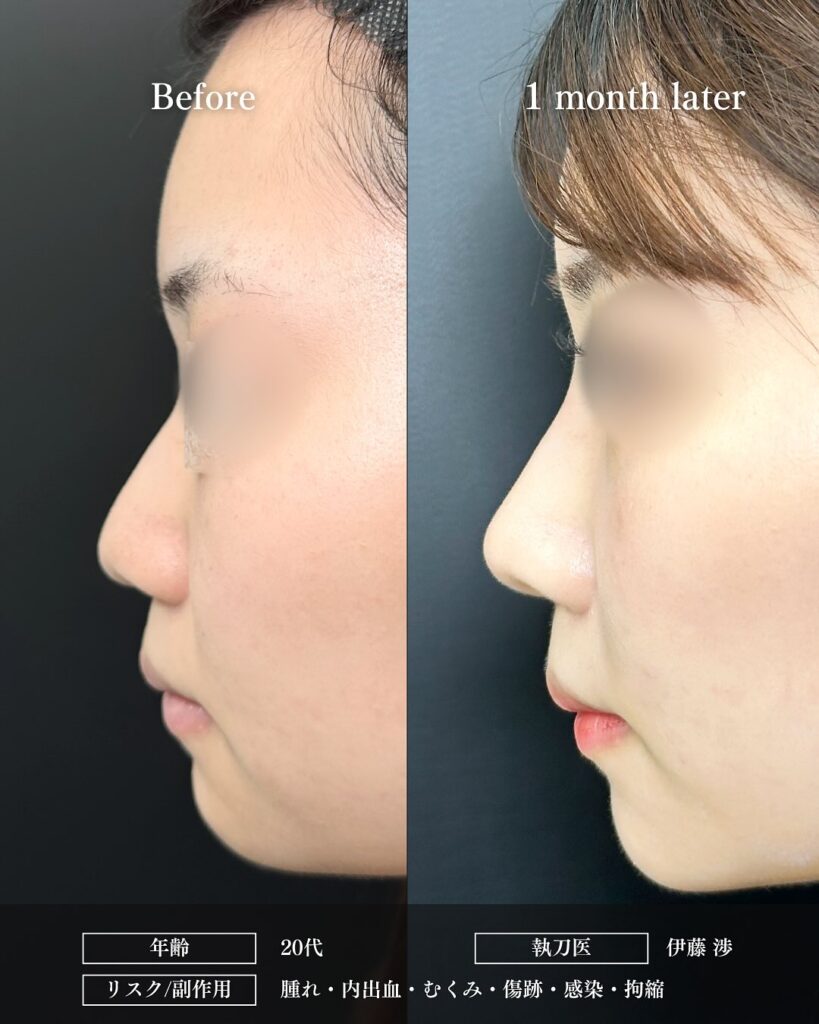 鼻尖形成と軟骨移植とプロテーゼの症例写真 (19)