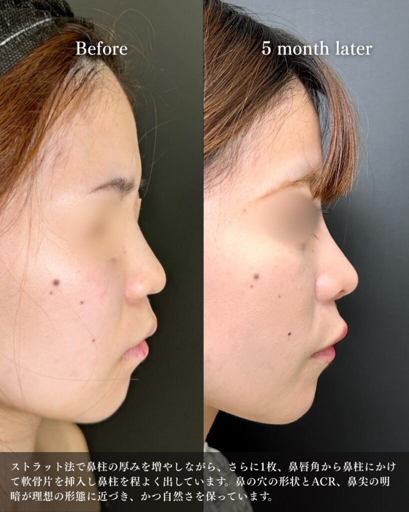 鼻尖形成と軟骨移植と鼻柱下降とプロテーゼの症例写真 (2)