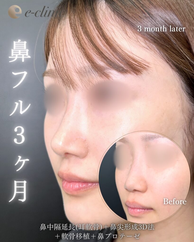 鼻中隔延長と鼻尖形成と軟骨移植とプロテーゼの症例写真 (8)