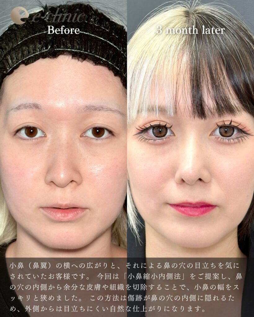 鼻中隔延長と鼻尖形成と軟骨移植と小鼻縮小の症例写真 (5)