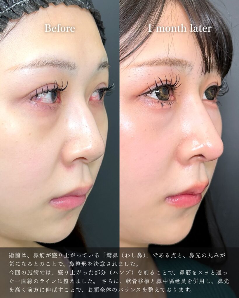 鼻中隔延長と鼻尖形成と軟骨移植と鷲鼻修正の症例写真 (6)