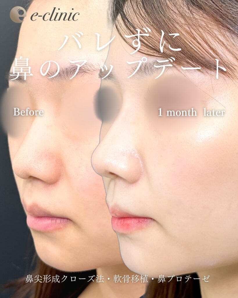 鼻尖形成と軟骨移植とプロテーゼの症例写真 (17)