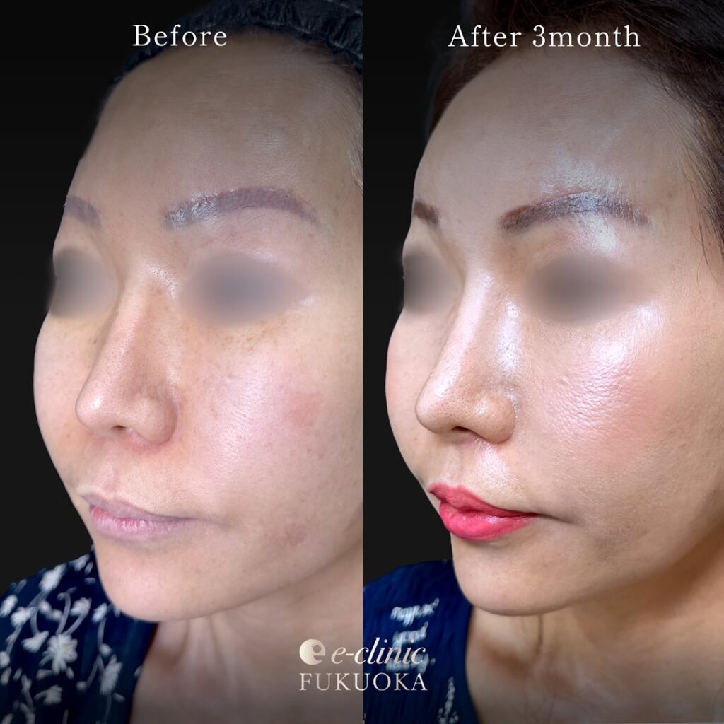 人中短縮と小鼻縮小の症例写真 (7)