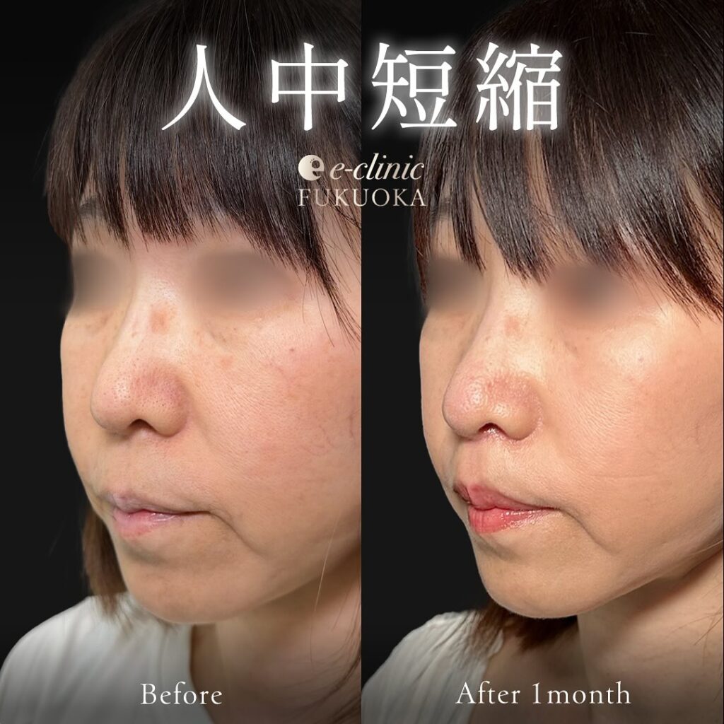 人中短縮の症例写真 (8)