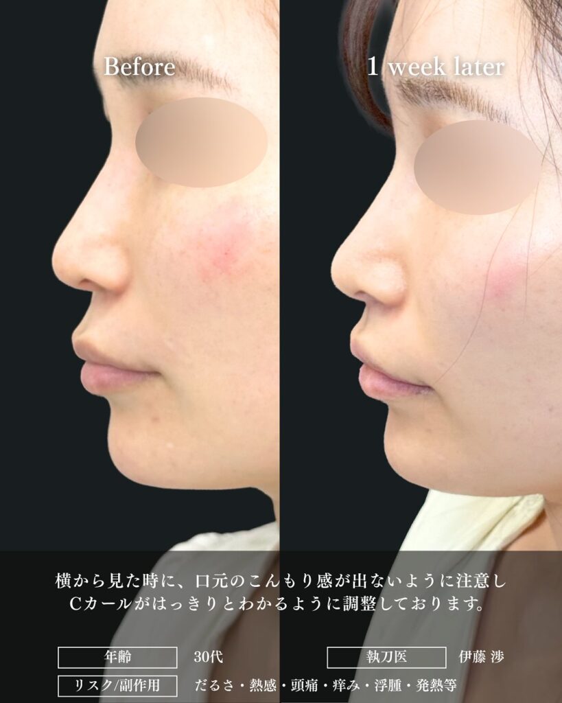 人中短縮の症例写真 (18)