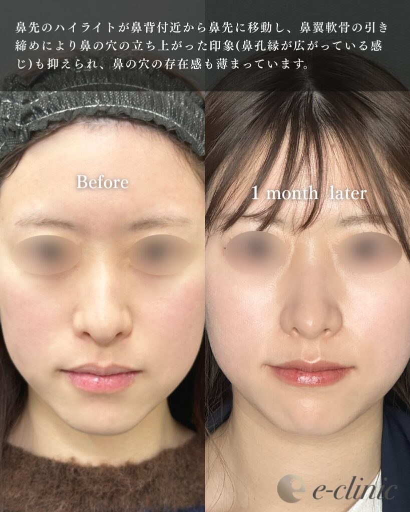 鼻尖形成と軟骨移植とプロテーゼの症例写真 (15)