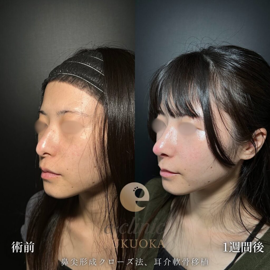 鼻尖形成と軟骨移植の症例写真 (10)