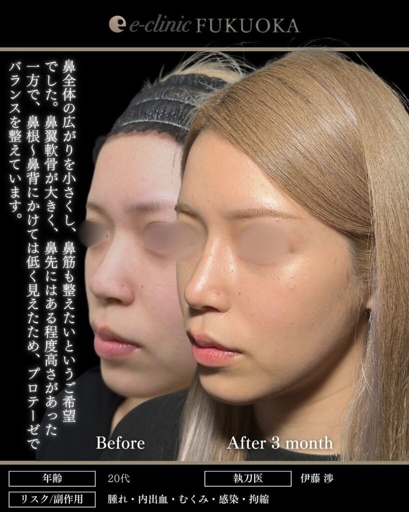 鼻尖形成と軟骨移植と小鼻縮小とプロテーゼの症例写真 (11)