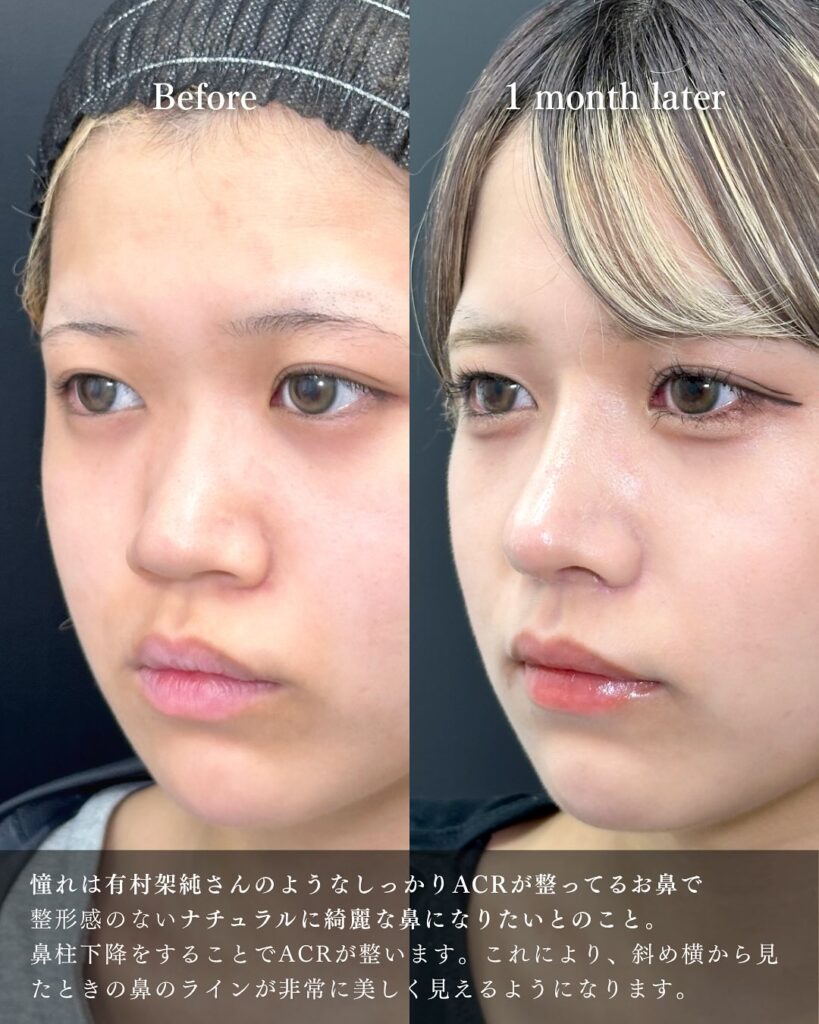 鼻中隔延長と鼻尖形成と軟骨移植と小鼻縮小と鼻柱下降とプロテーゼの症例写真 (9)