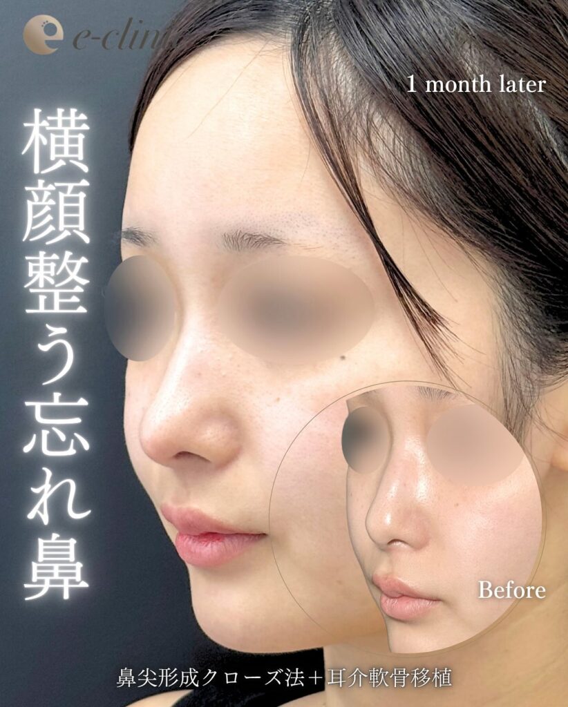 鼻尖形成と軟骨移植の症例写真 (40)