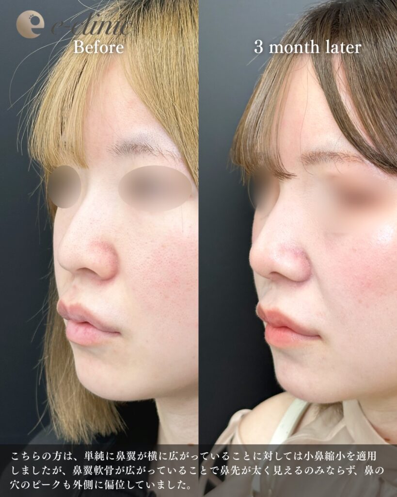 鼻尖形成と鼻中隔延長と耳介軟骨移植と小鼻縮小と鼻柱下降の症例写真 (5)