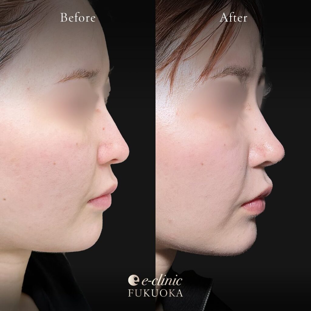 鼻尖形成と軟骨移植の症例写真 (13)