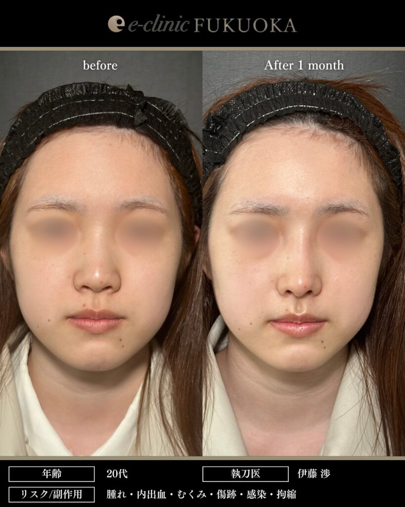 鼻中隔延長と鼻尖形成と耳介軟骨移植とプロテーゼと小鼻縮小の症例写真 (3)