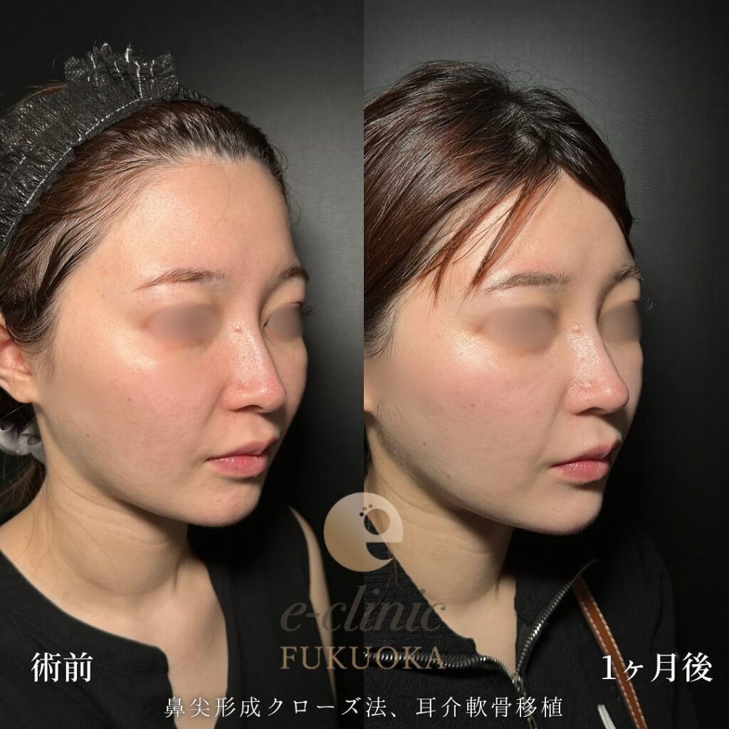 鼻尖形成と軟骨移植の症例写真 (8)