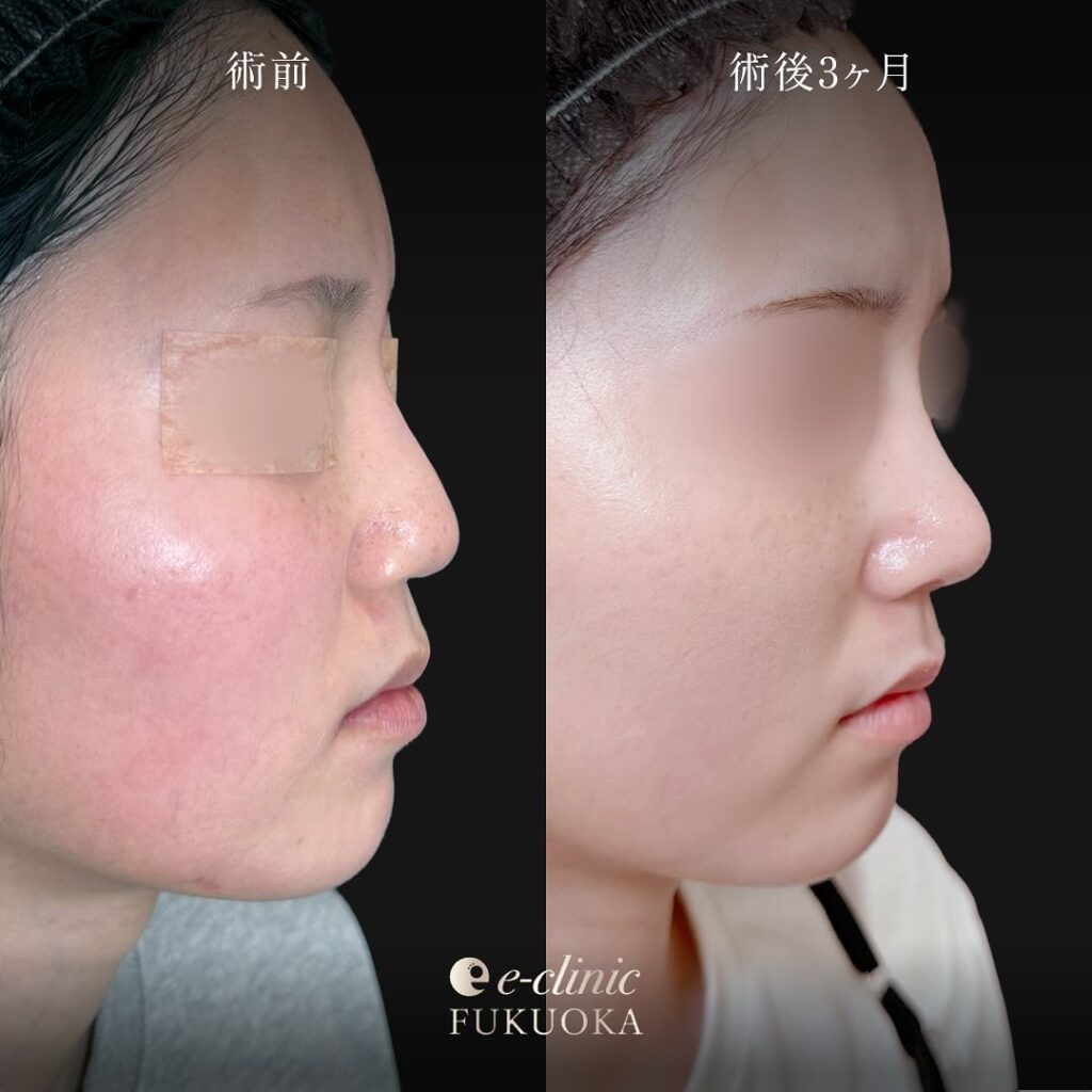 鼻尖形成と軟骨移植と鼻柱下降の症例写真 (2)