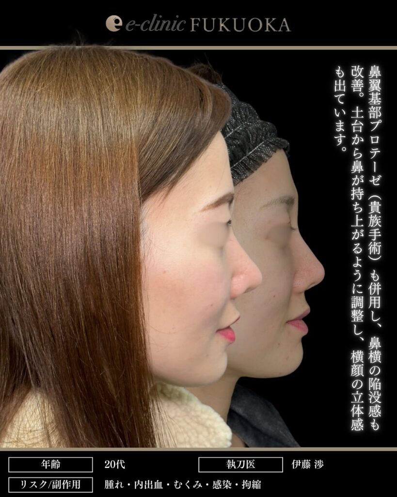 鼻尖形成と軟骨移植と小鼻縮小とプロテーゼと貴族手術の症例写真 (2)