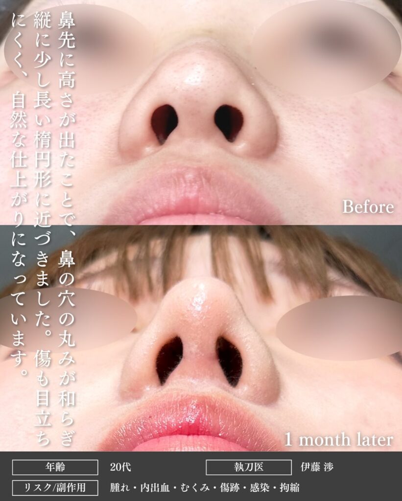 鼻尖形成と軟骨移植とプロテーゼの症例写真 (9)