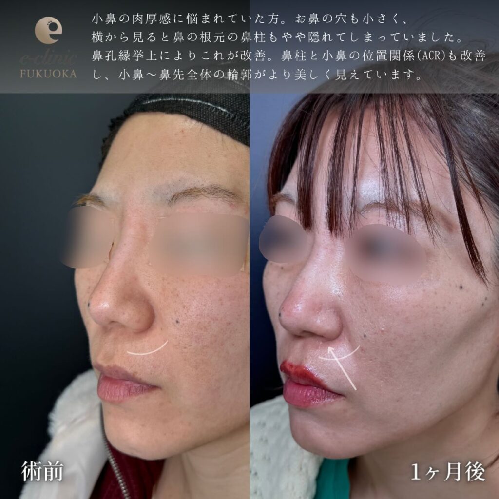 鼻孔縁挙上の症例写真 (4)