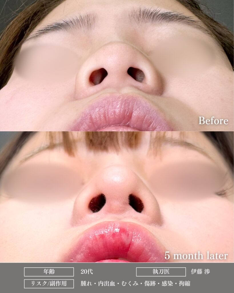 鼻尖形成と軟骨移植と鼻柱下降とプロテーゼの症例写真 (1)