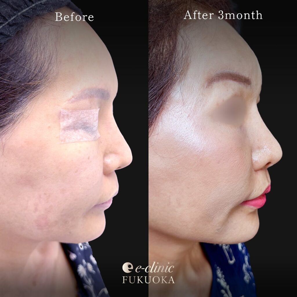 人中短縮と小鼻縮小の症例写真 (6)