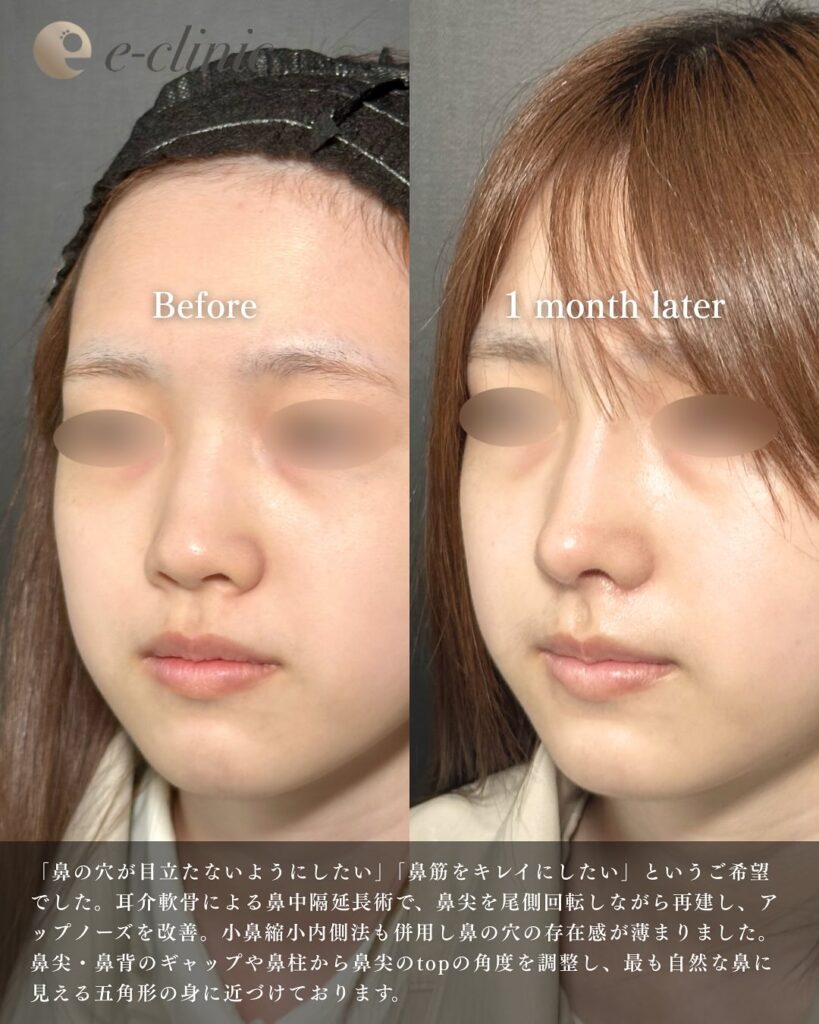 鼻尖形成と鼻中隔延長と耳介軟骨移植とプロテーゼと小鼻縮小の症例写真 (5)