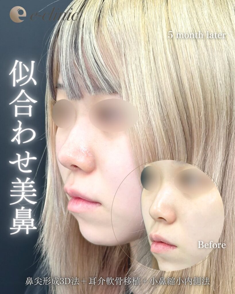 鼻尖形成と軟骨移植と小鼻縮小の症例写真 (28)