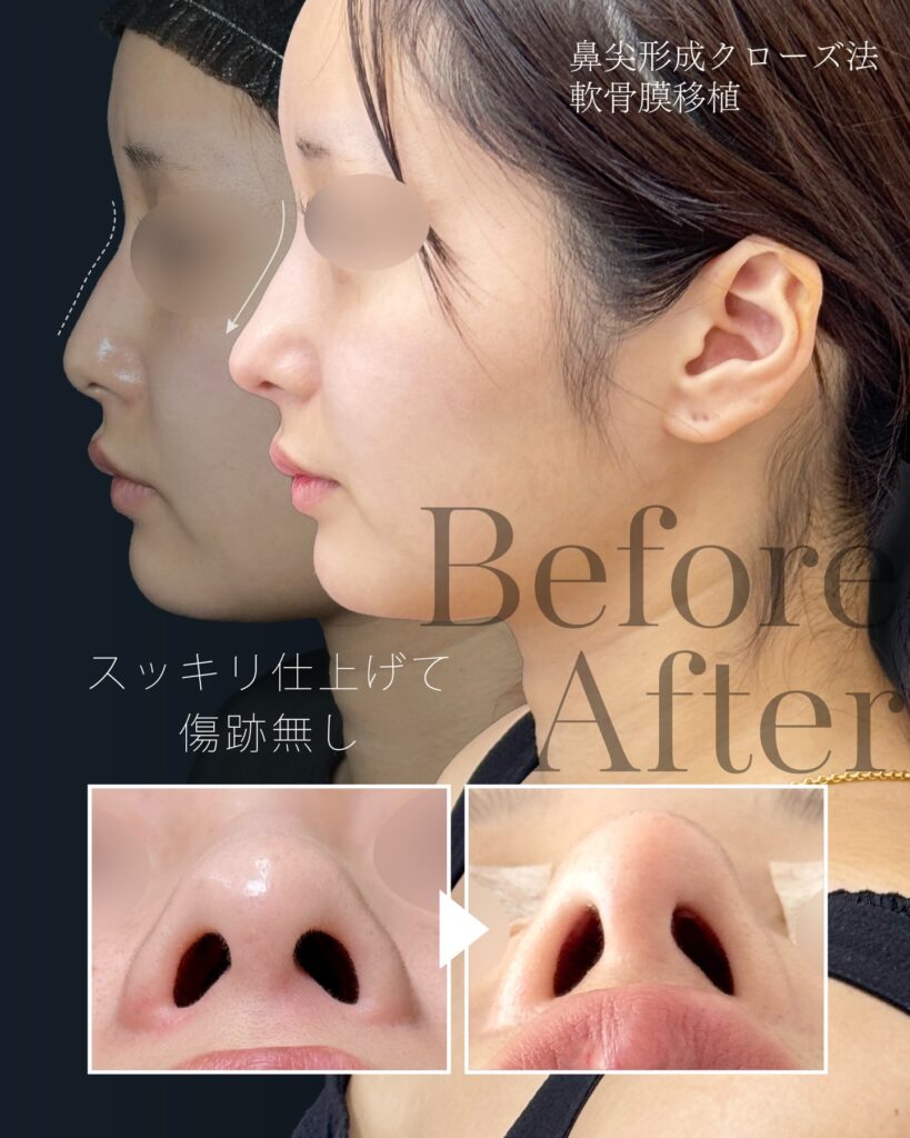 鼻尖形成と軟骨移植の症例写真 (37)