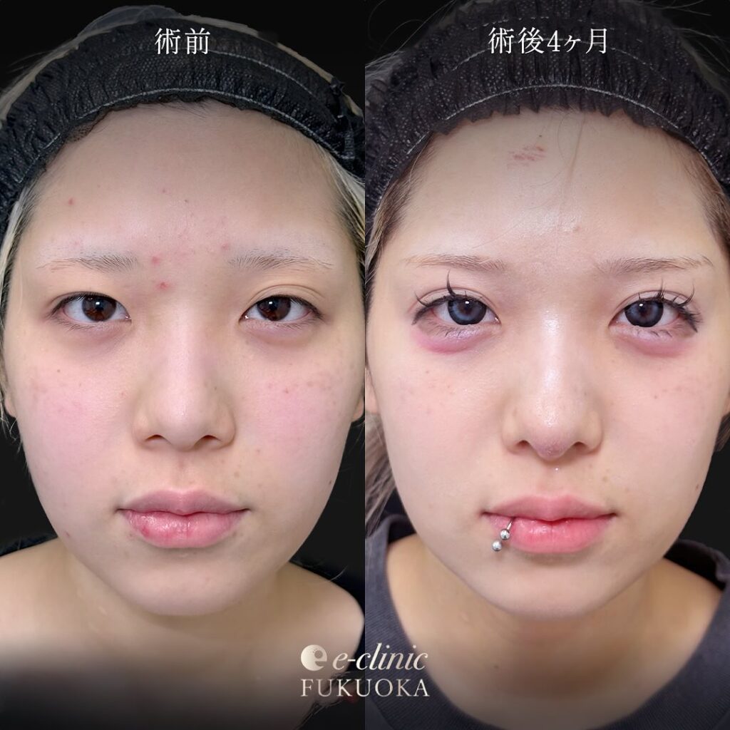 鼻尖形成と軟骨意欲と小鼻縮小の症例写真 (2)