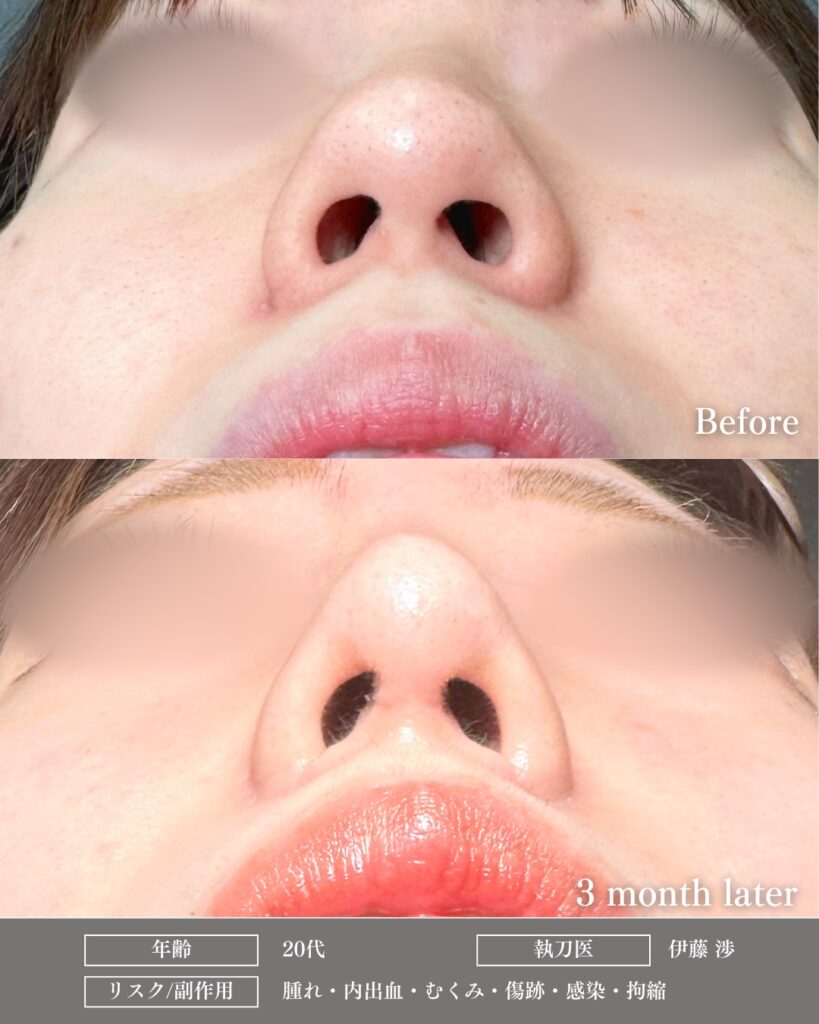 鼻尖形成と軟骨移植とプロテーゼと小鼻縮小の症例写真 (17)